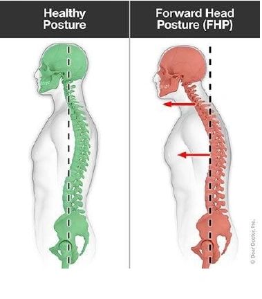 forward-head-posture-jaw-issues-tmd-and-pt-clinical-overview